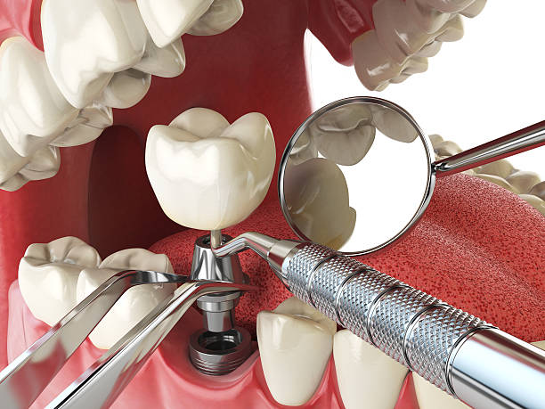 Best Emergency Wisdom Tooth Extraction in Warsaw, IN